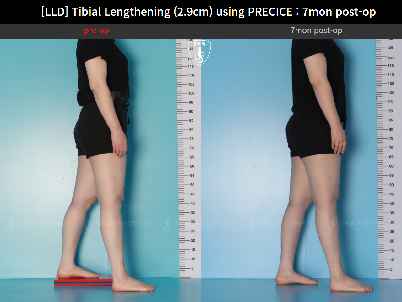 Before and after adult lld, case 62389039, image 4, Dr. Donghoon institute (DALRI)