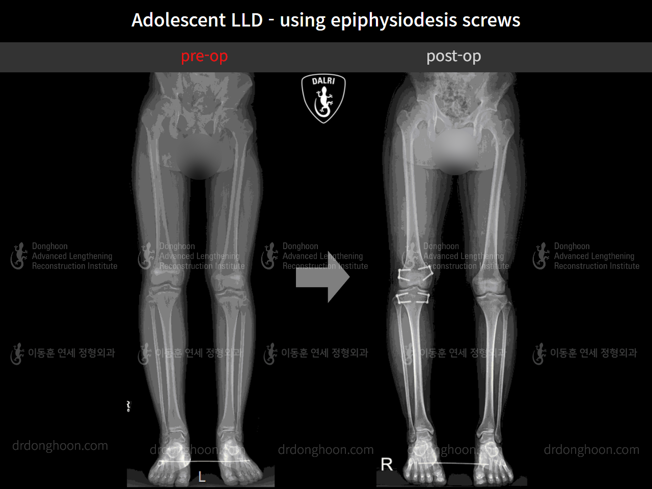 Before and after paediatric & adolescent lld, case 10452092, image 4, Dr. Donghoon institute (DALRI)