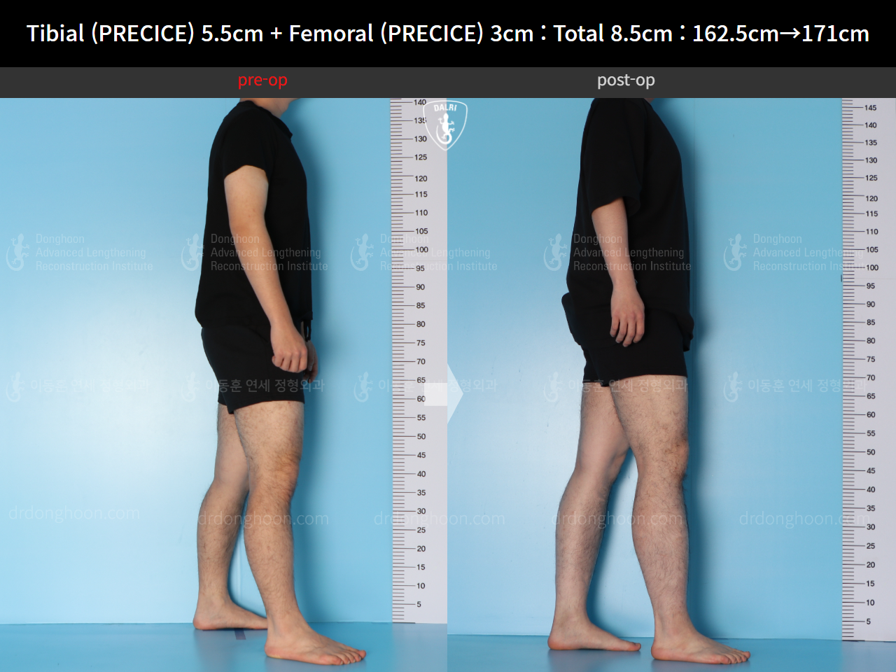 Before and after cll precice, case 15140008, image 4, Dr. Donghoon institute (DALRI)
