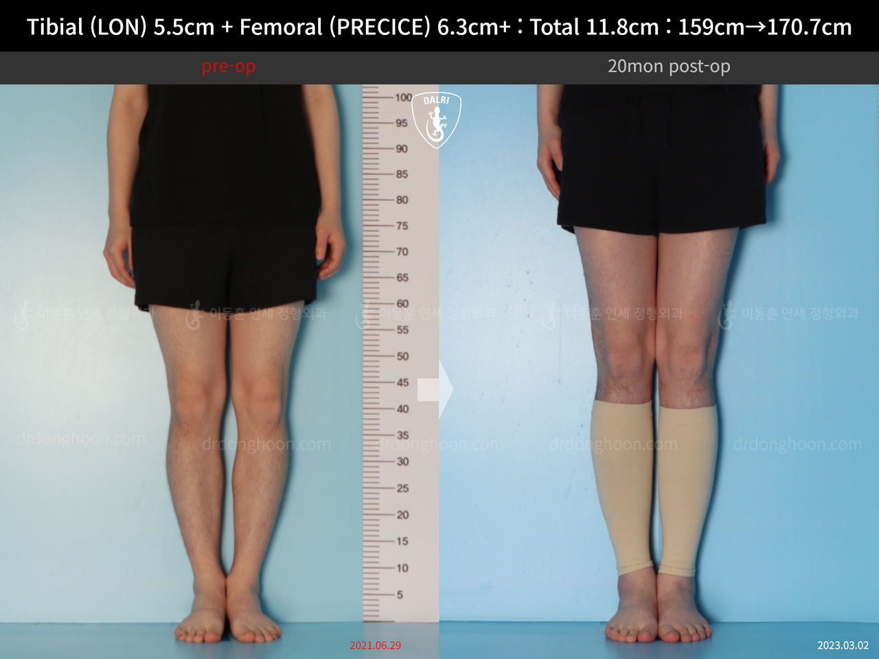 Before and after cll lon, case 14390077, image 7, Dr. Donghoon institute (DALRI)