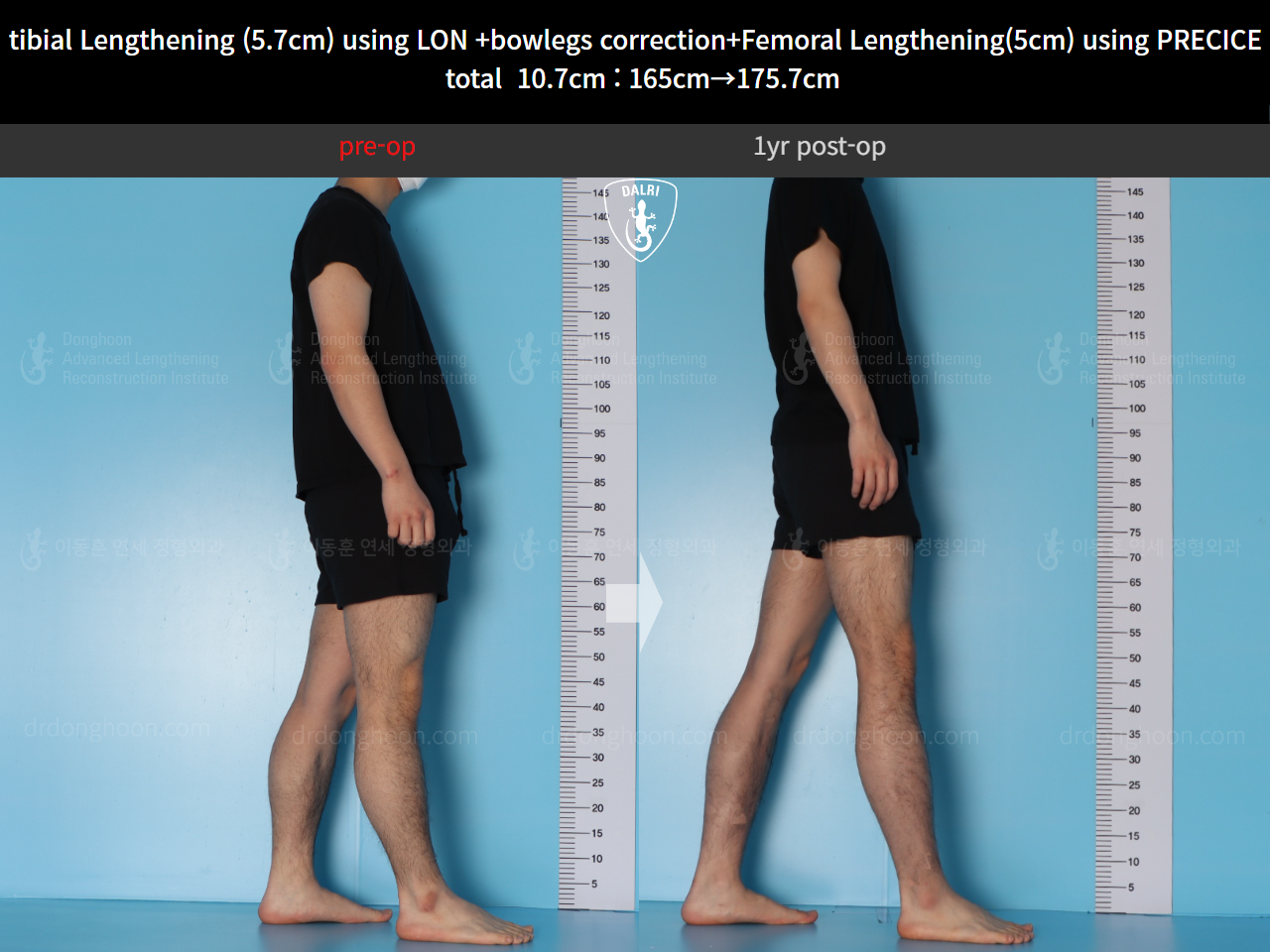 Before and after cll precice, case 20363375, image 5, Dr. Donghoon institute (DALRI)