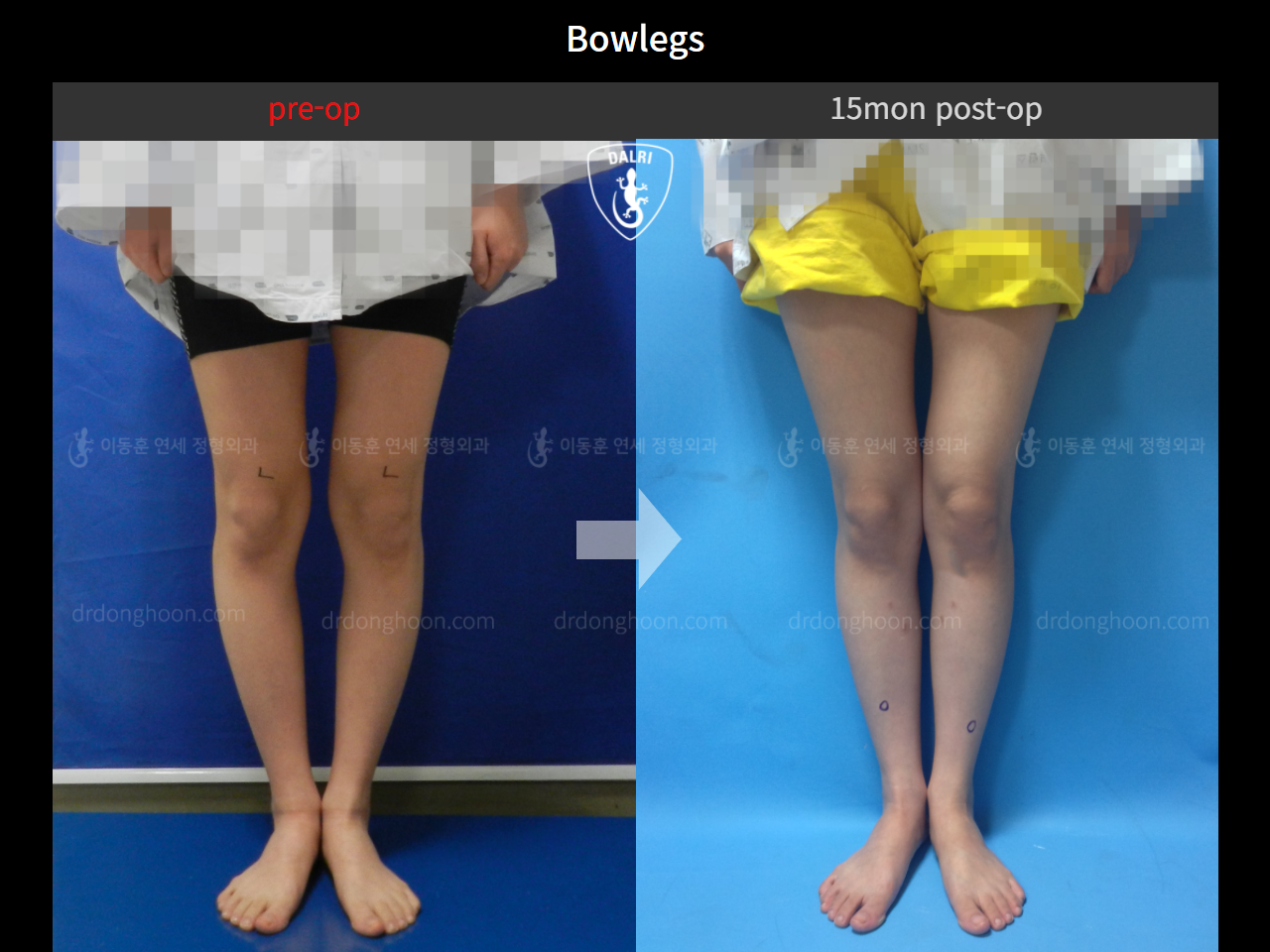 Before and after adult bowlegs, case 4310970, image 4, Dr. Donghoon institute (DALRI)