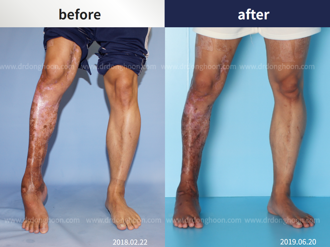 Before and after post-trauma deformity, case 4251815, image 1, Dr. Donghoon institute (DALRI)