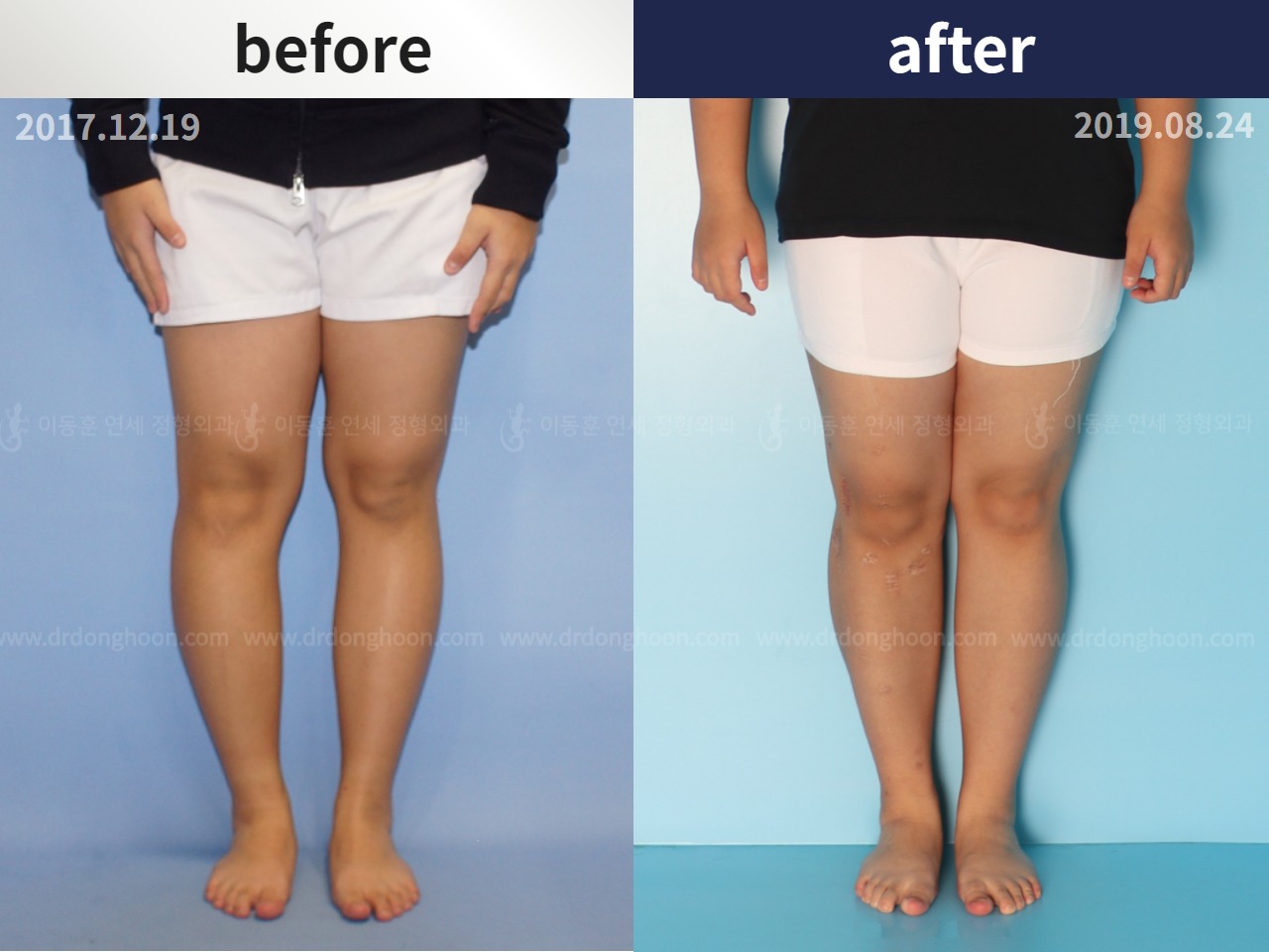 Before and after paediatric & adolescent bowlegs, case 4320272, image 1, Dr. Donghoon institute (DALRI)