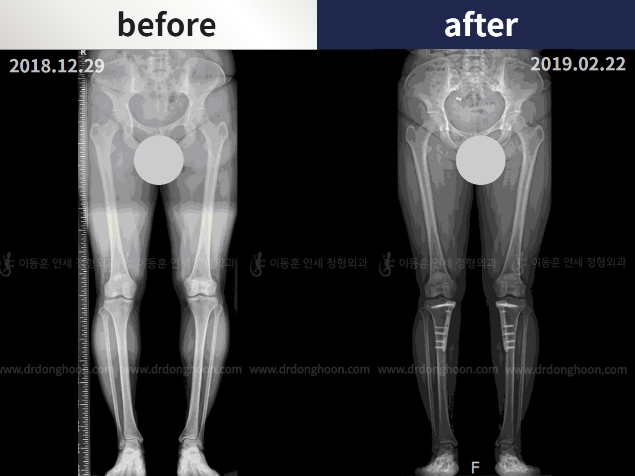 Before and after adult bowlegs, case 4586179, image 2, Dr. Donghoon institute (DALRI)