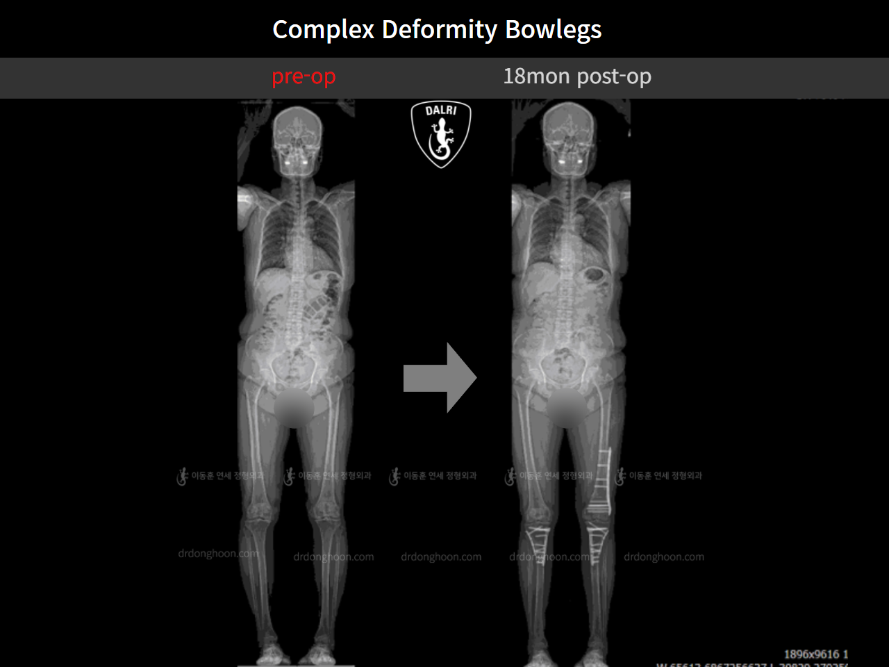 Before and after osteotomy for knee osteoarthritis, case 11337460, image 8, Dr. Donghoon institute (DALRI)