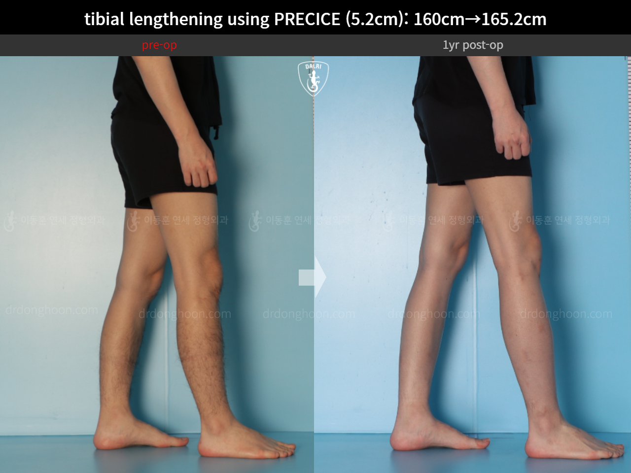 Before and after cll precice, case 15213098, image 11, Dr. Donghoon institute (DALRI)