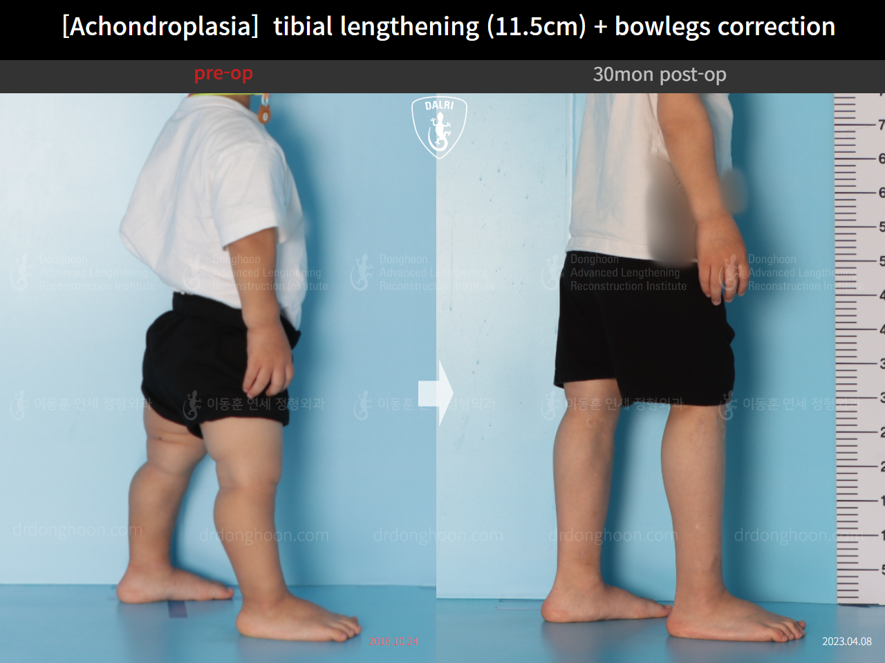 Before and after paediatric congenital condition, case 14957539, image 4, Dr. Donghoon institute (DALRI)