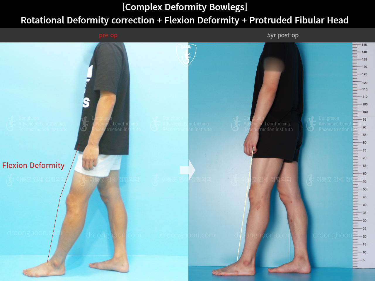 Before and after complex deformity, case 15944755, image 6, Dr. Donghoon institute (DALRI)