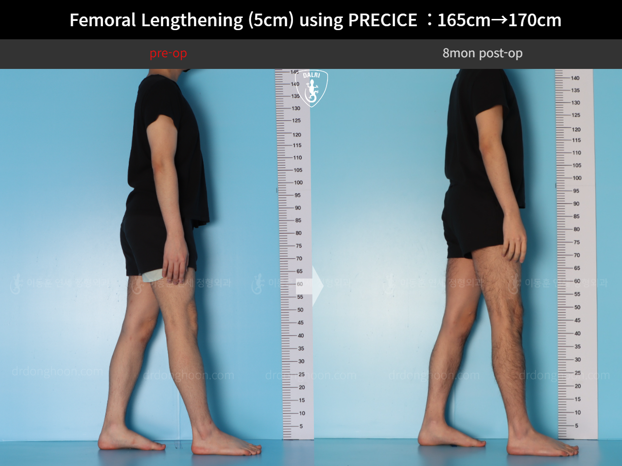 Before and after cll precice, case 18356944, image 5, Dr. Donghoon institute (DALRI)