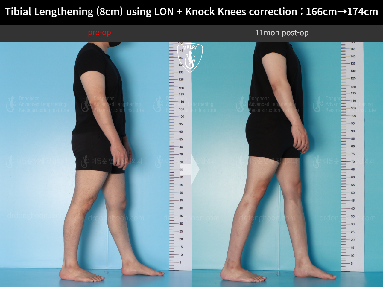 Before and after cll + deformity correction, case 20789954, image 4, Dr. Donghoon institute (DALRI)