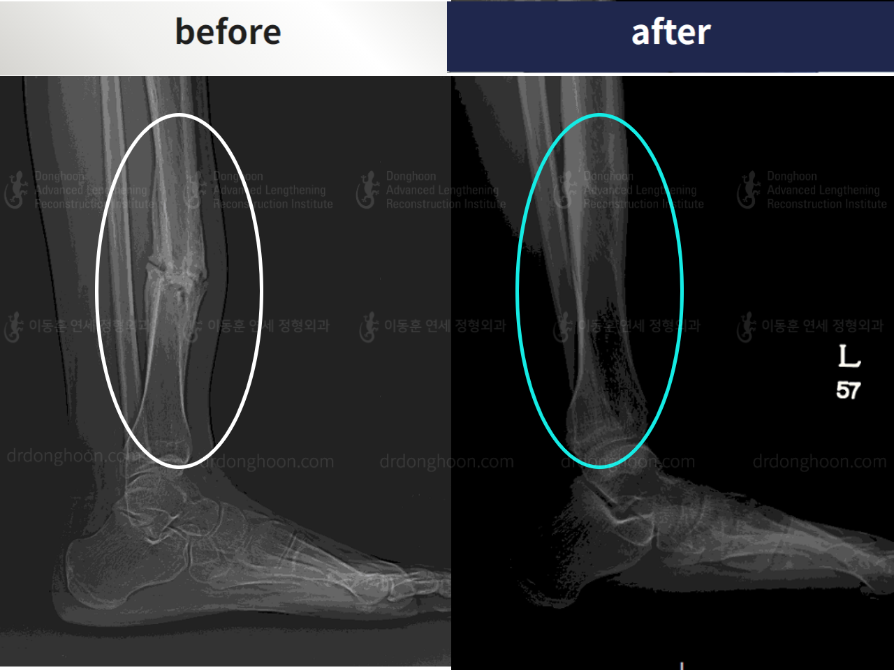 Before and after post-trauma deformity, case 4355008, image 6, Dr. Donghoon institute (DALRI)