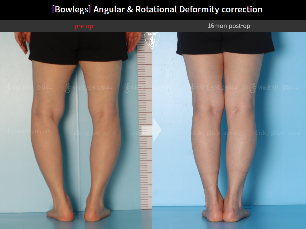 Before and after adult bowlegs, case 14637299, image 4, Dr. Donghoon institute (DALRI)