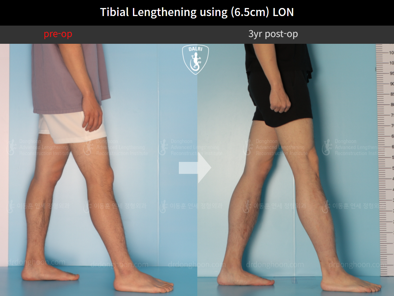 Before and after cll lon, case 9487829, image 8, Dr. Donghoon institute (DALRI)