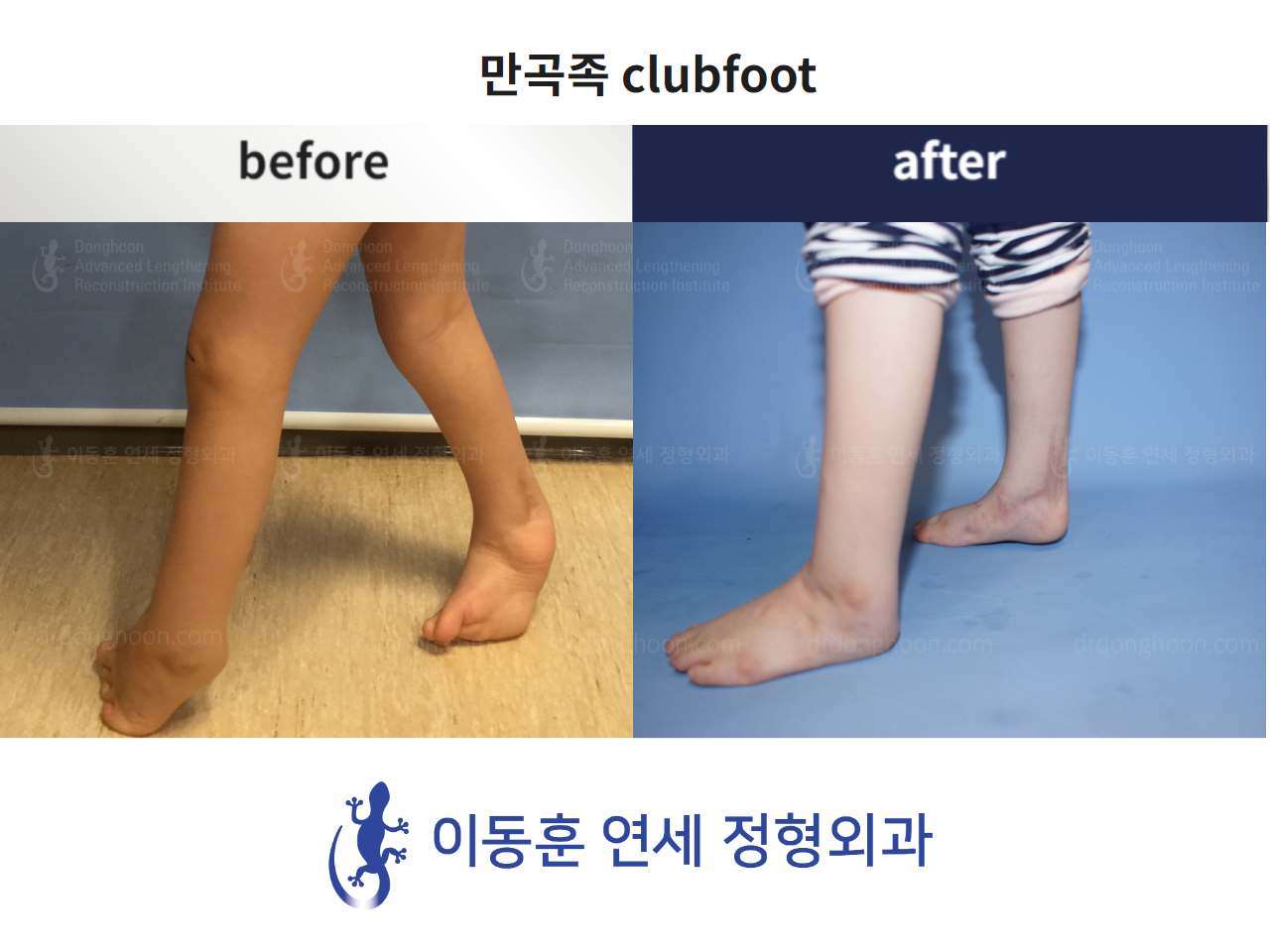 Before and after paediatric congenital condition, case 4304743, image 3, Dr. Donghoon institute (DALRI)