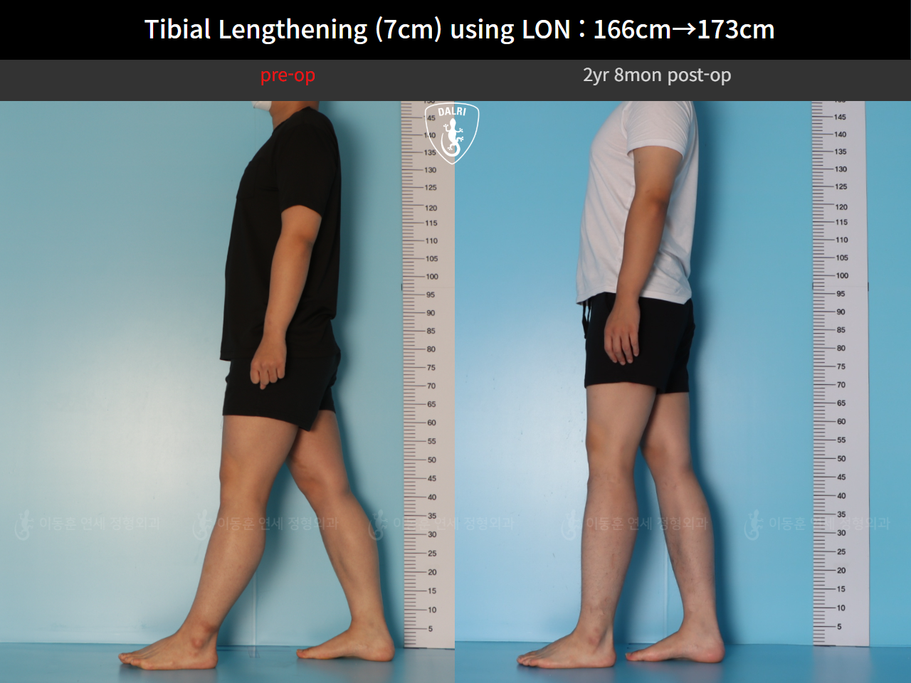 Before and after cll lon, case 127679780, image 3, Dr. Donghoon institute (DALRI)