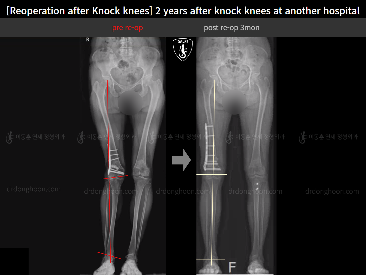 Before and after reoperation after deformity correction, case 15622876, image 13, Dr. Donghoon institute (DALRI)