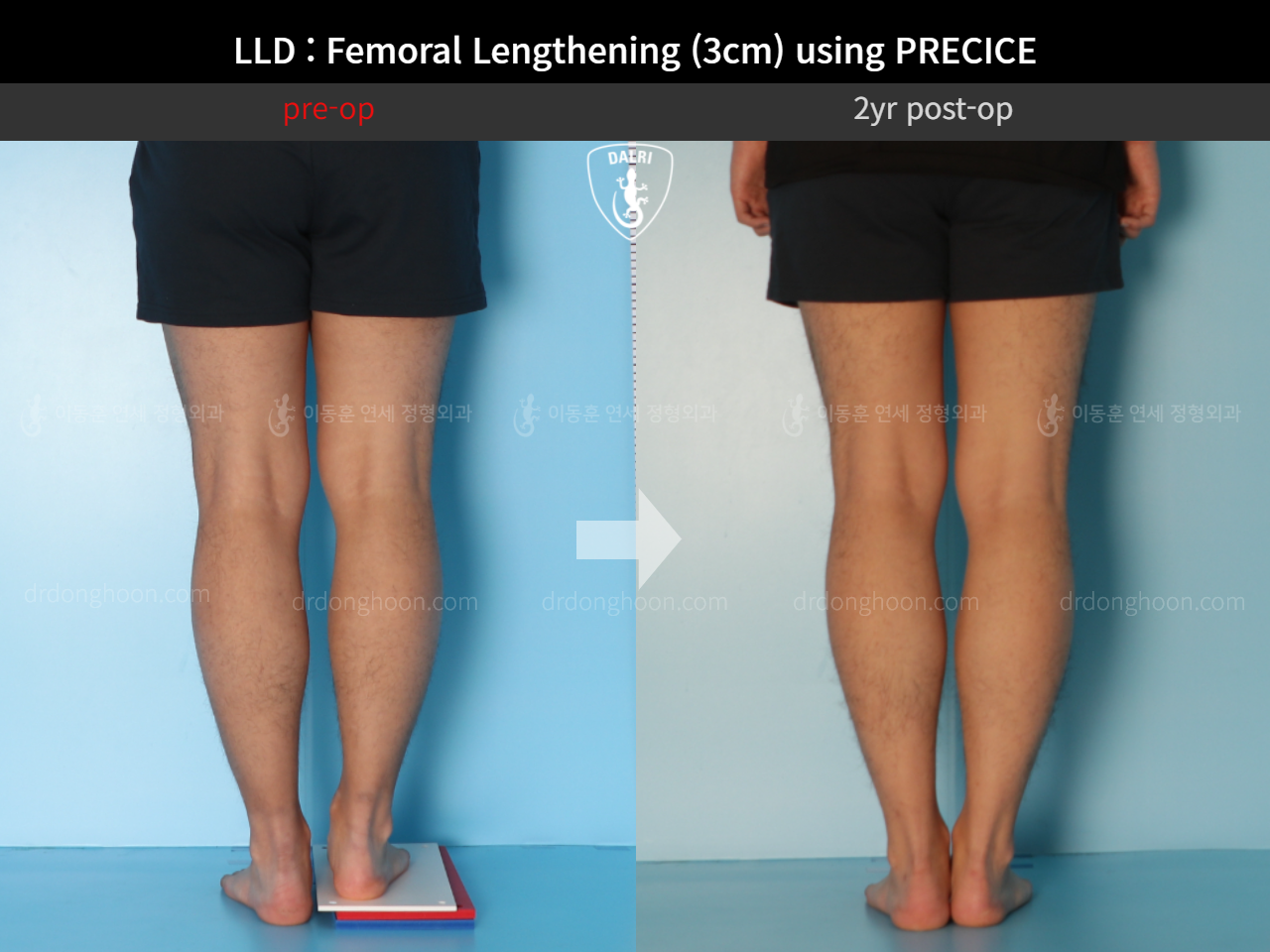 Before and after adult lld, case 10665047, image 4, Dr. Donghoon institute (DALRI)