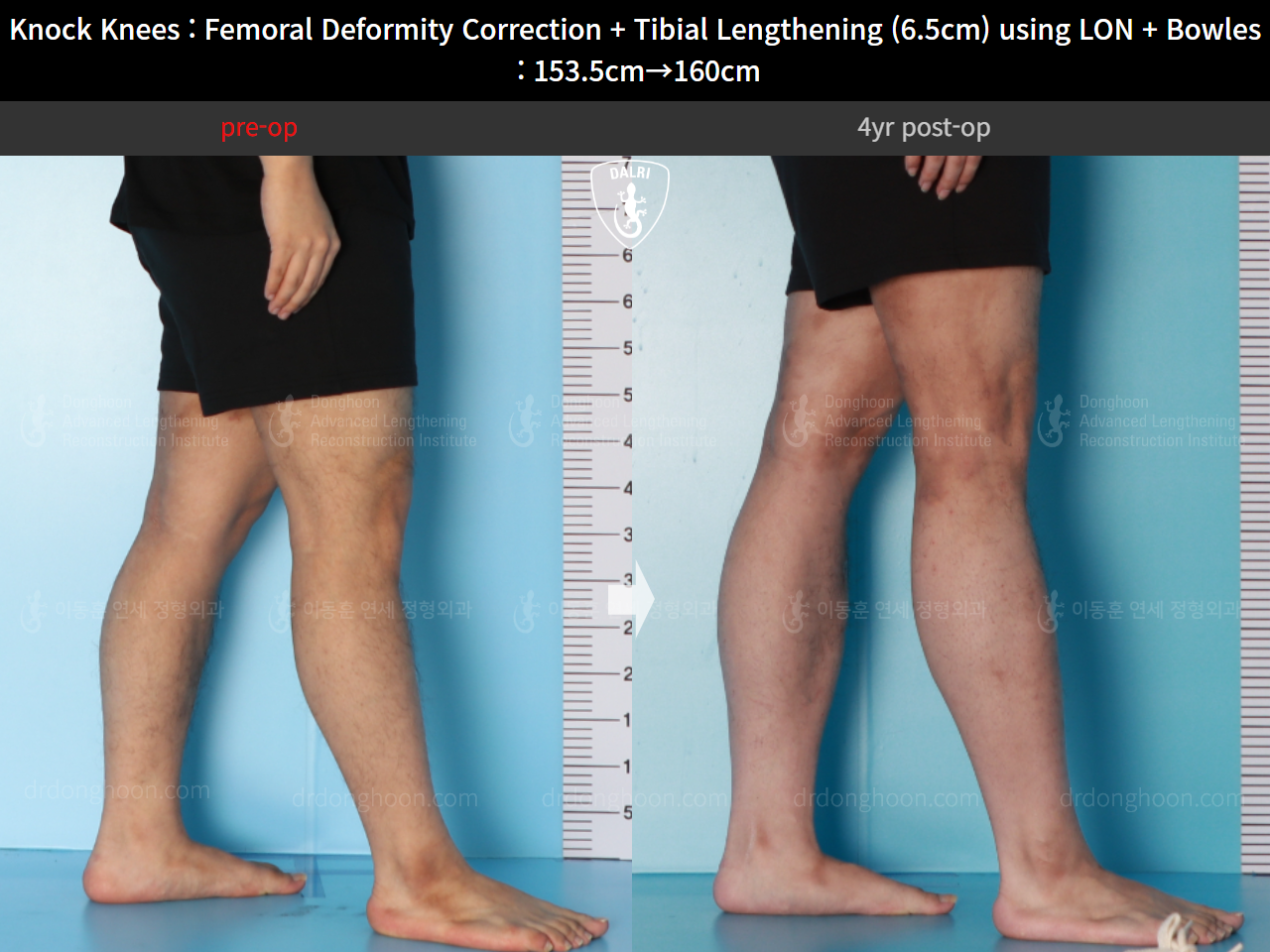 Before and after cll lon, case 16723818, image 7, Dr. Donghoon institute (DALRI)