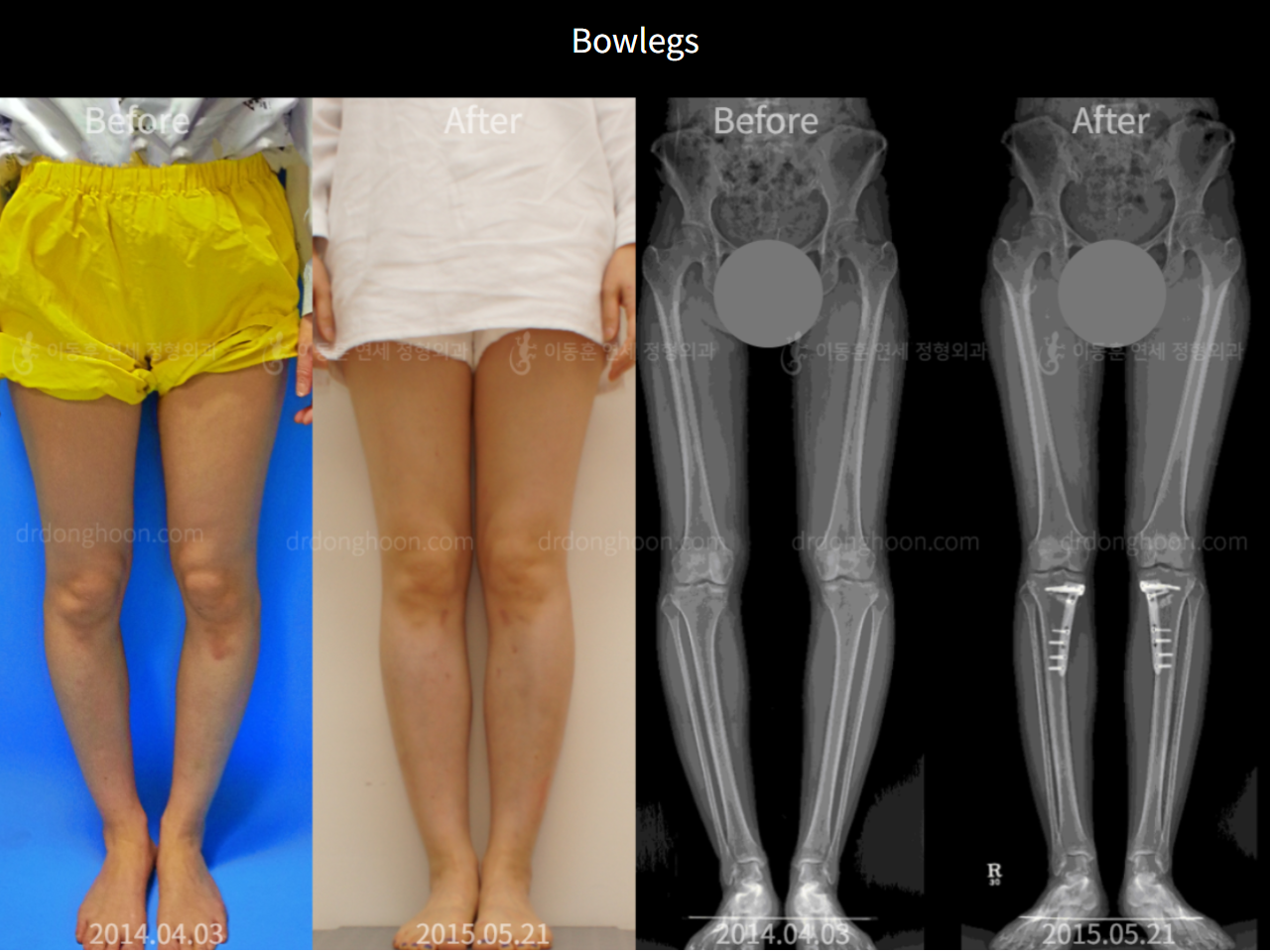 Before and after adult bowlegs, case 6779432, image 1, Dr. Donghoon institute (DALRI)