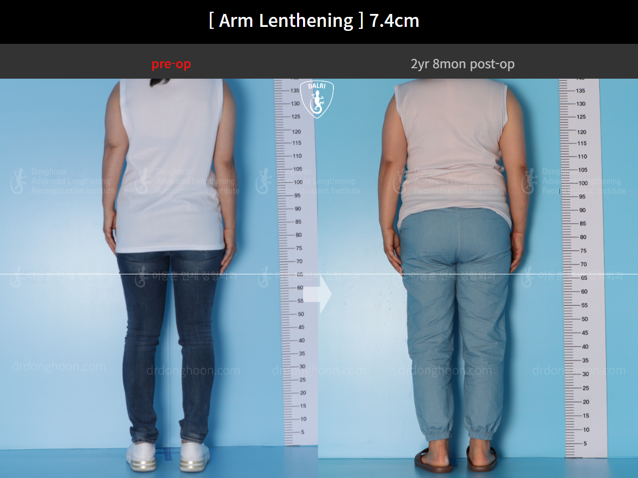Before and after arm lengthening, case 15460631, image 5, Dr. Donghoon institute (DALRI)