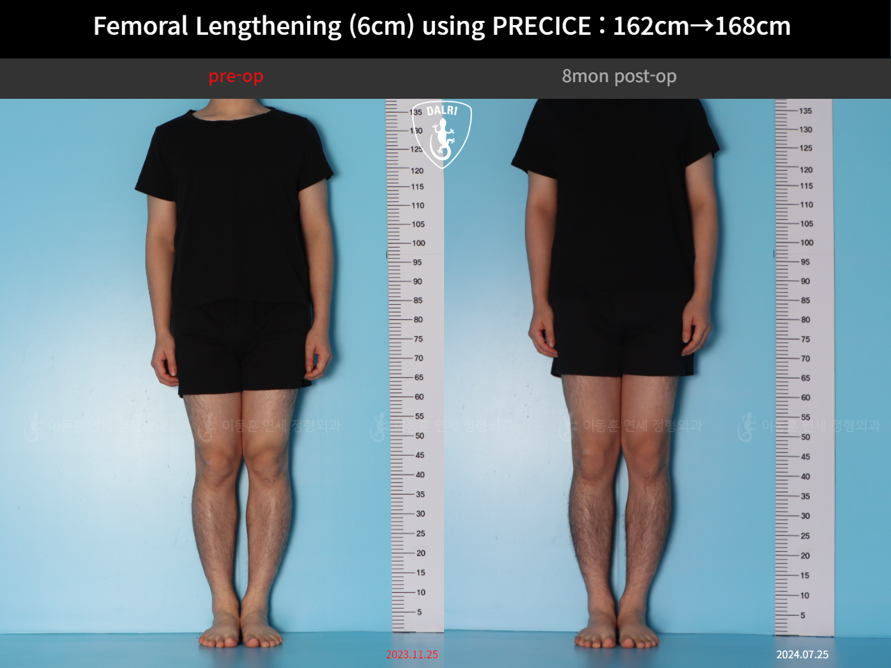 Before and after cll precice, case 52565195, image 1, Dr. Donghoon institute (DALRI)