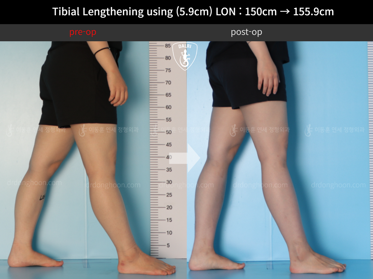 Before and after cll lon, case 12207071, image 7, Dr. Donghoon institute (DALRI)