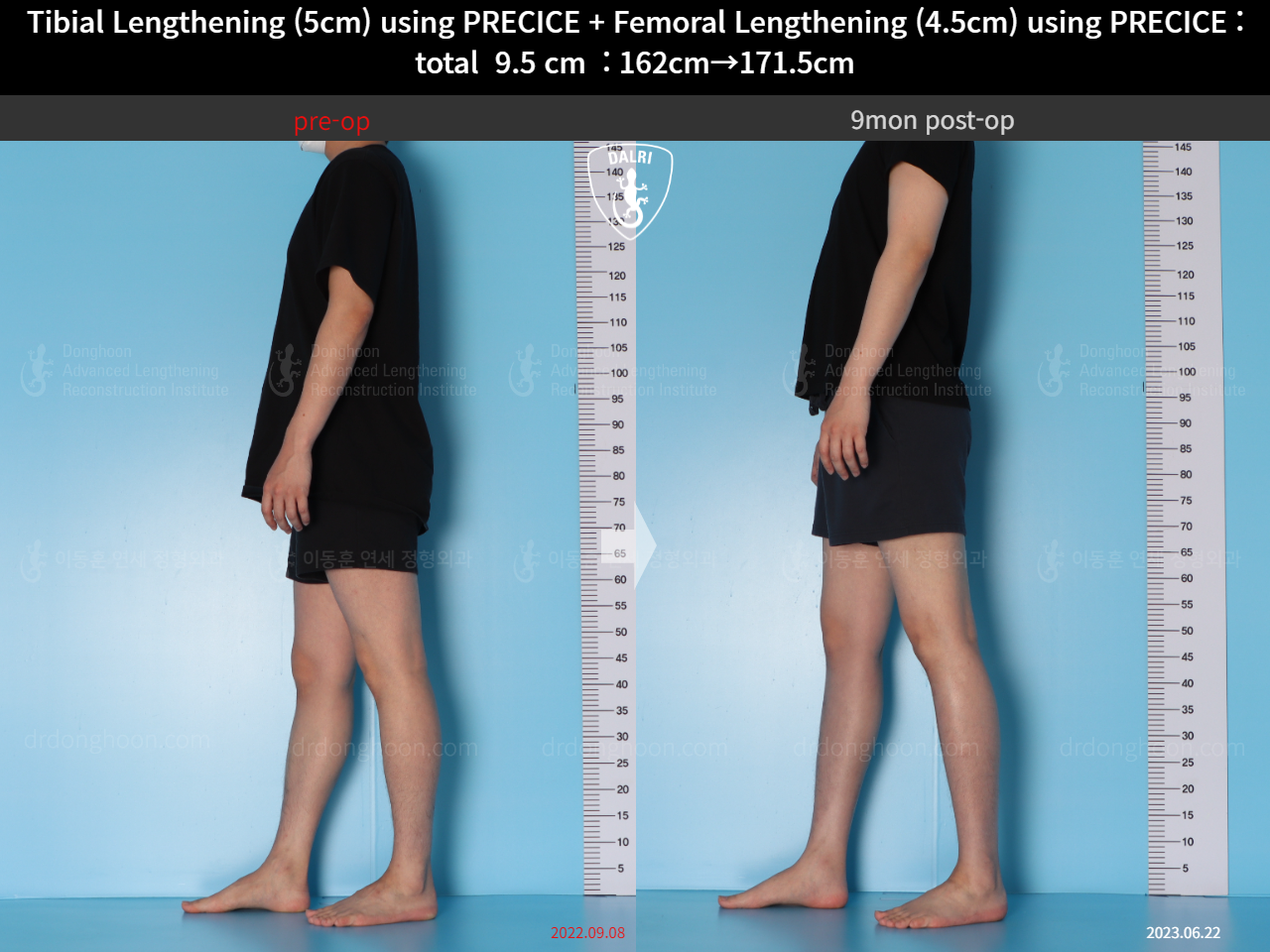 Before and after cll precice, case 15344460, image 8, Dr. Donghoon institute (DALRI)
