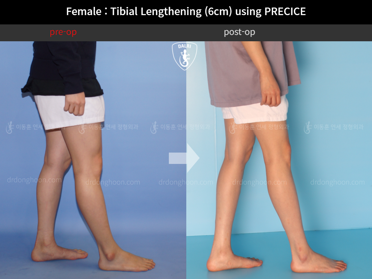 Before and after cll precice, case 11653827, image 8, Dr. Donghoon institute (DALRI)