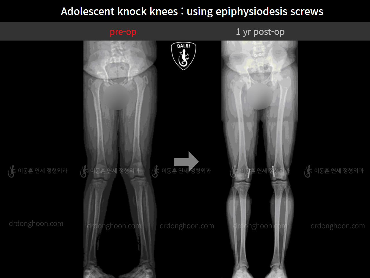 Before and after paediatric & adolescent knock knees, case 9331989, image 6, Dr. Donghoon institute (DALRI)