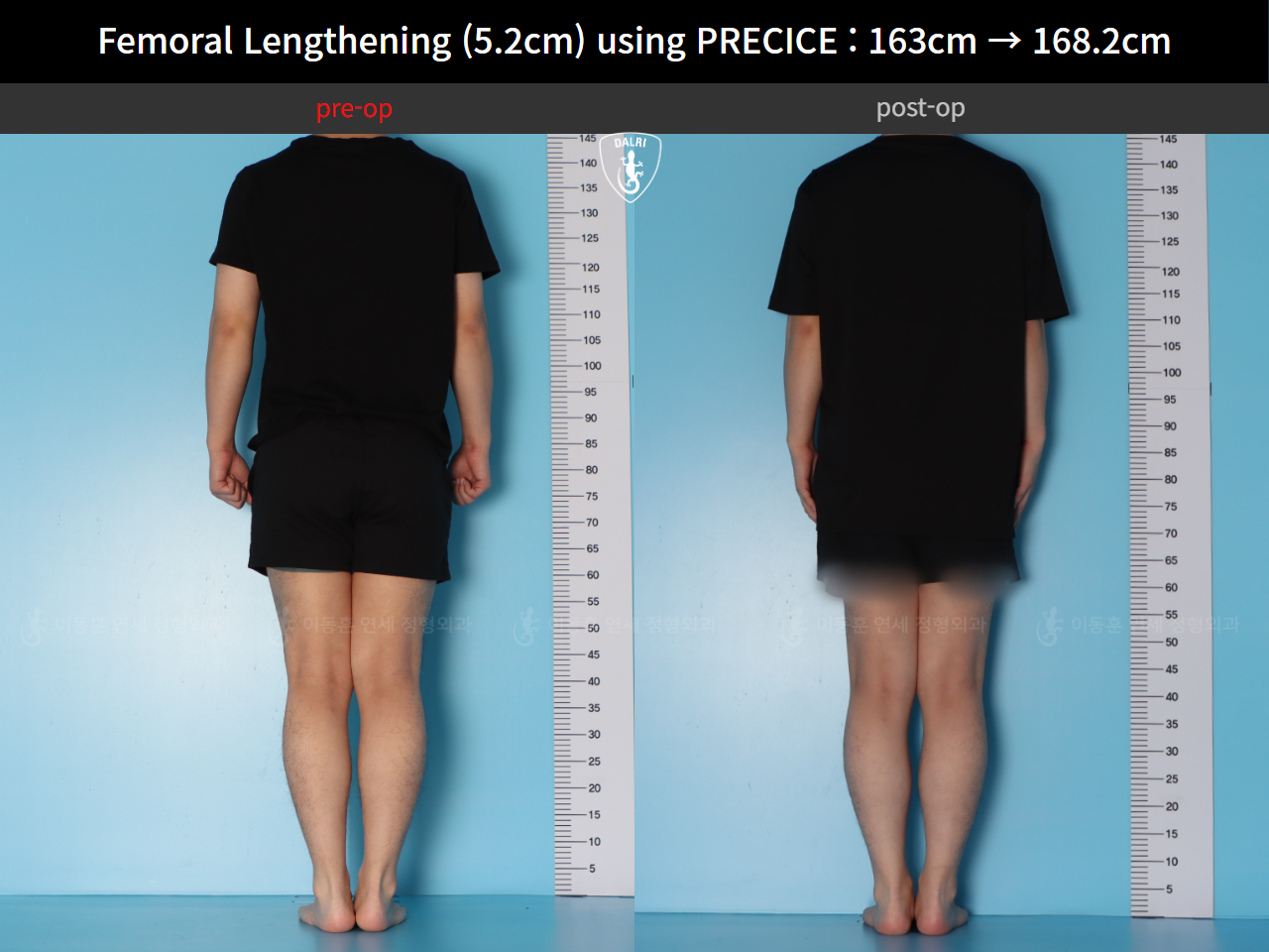 Before and after cll precice, case 55585697, image 2, Dr. Donghoon institute (DALRI)