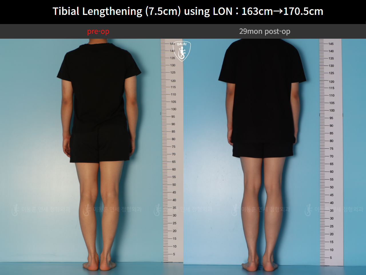 Before and after cll lon, case 127341676, image 2, Dr. Donghoon institute (DALRI)