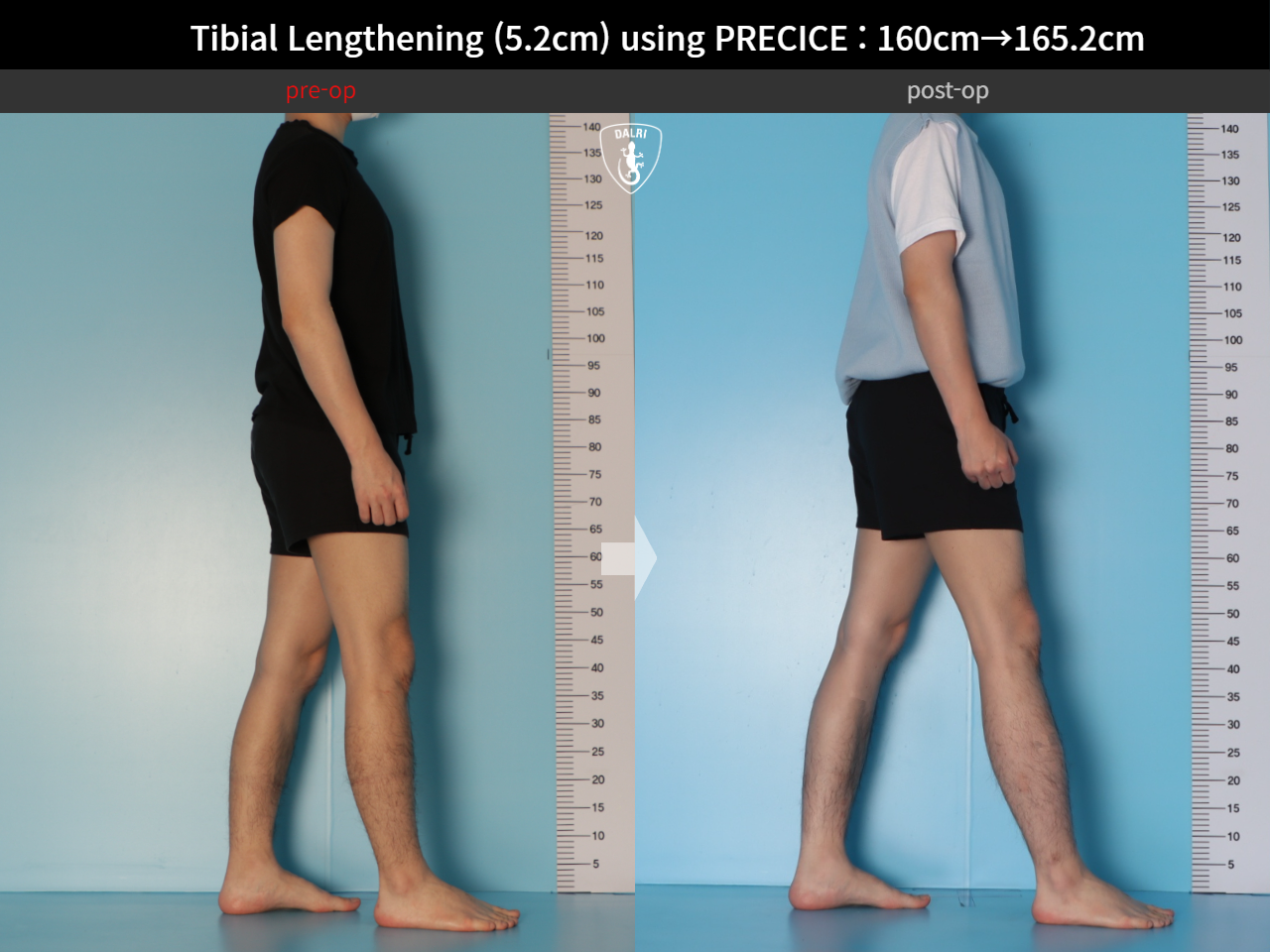 Before and after cll precice, case 27370351, image 3, Dr. Donghoon institute (DALRI)