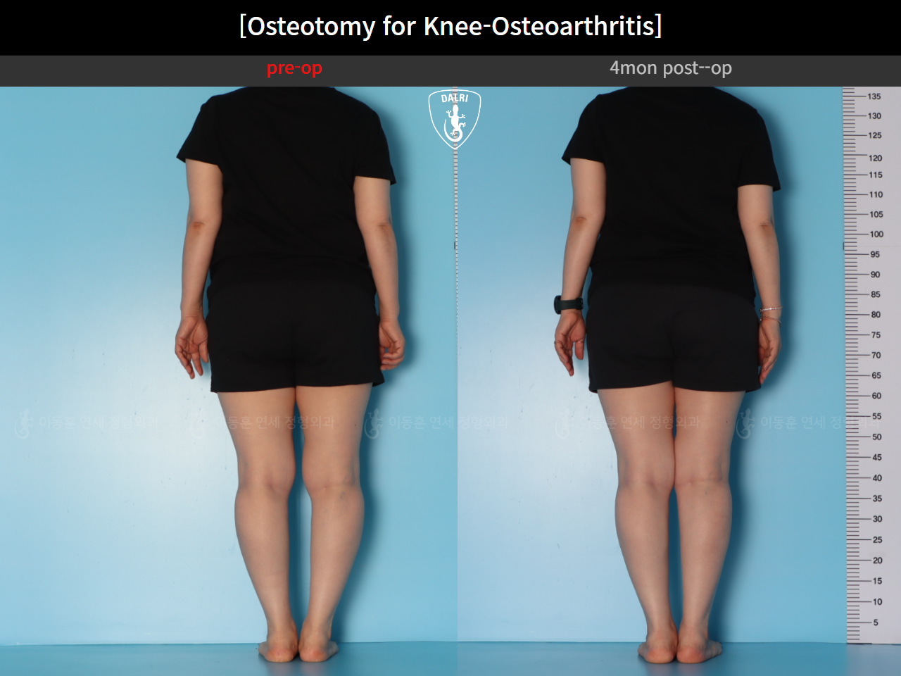Before and after osteotomy for knee osteoarthritis, case 39778471, image 4, Dr. Donghoon institute (DALRI)