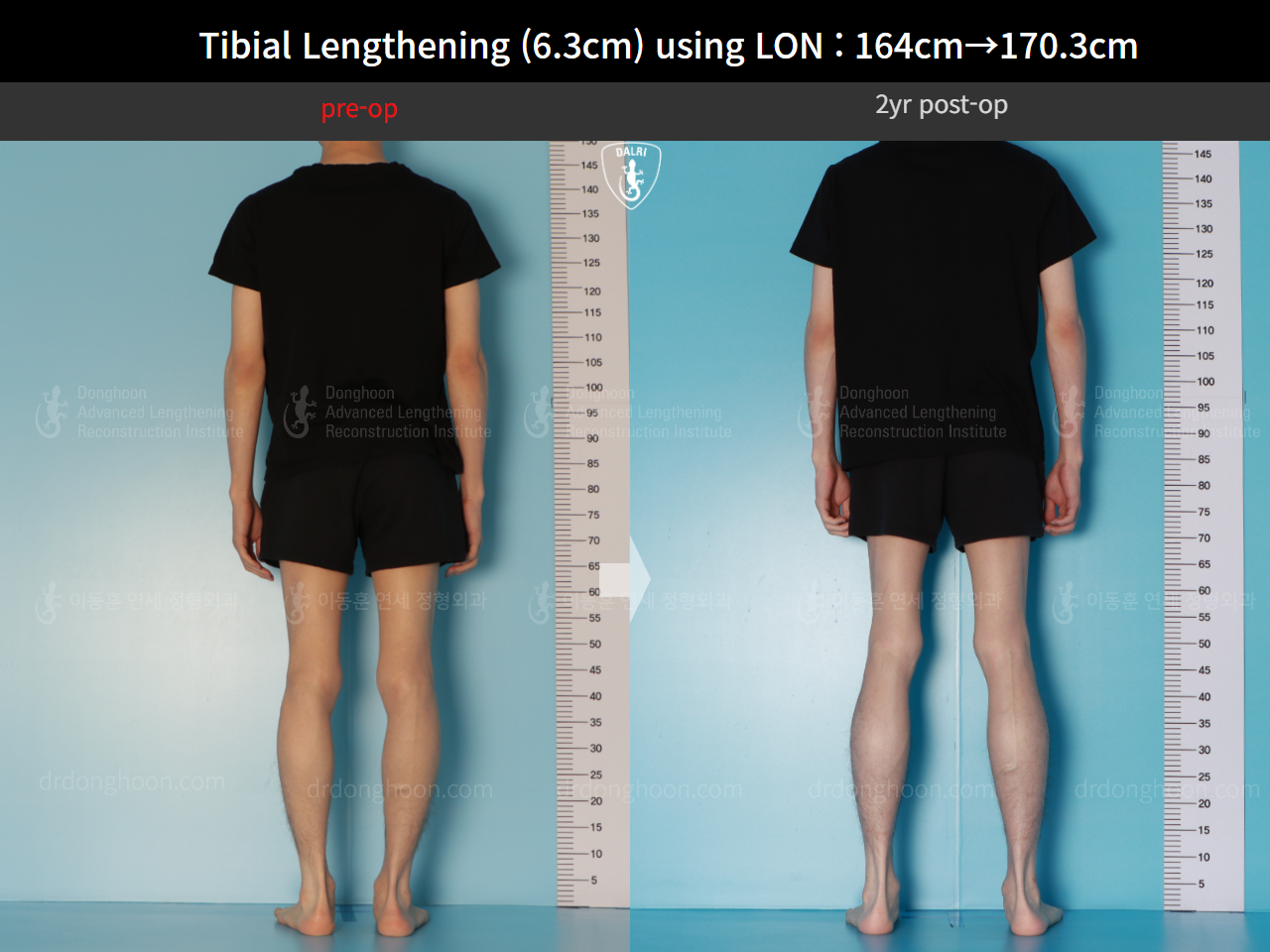 Before and after cll lon, case 16723608, image 4, Dr. Donghoon institute (DALRI)