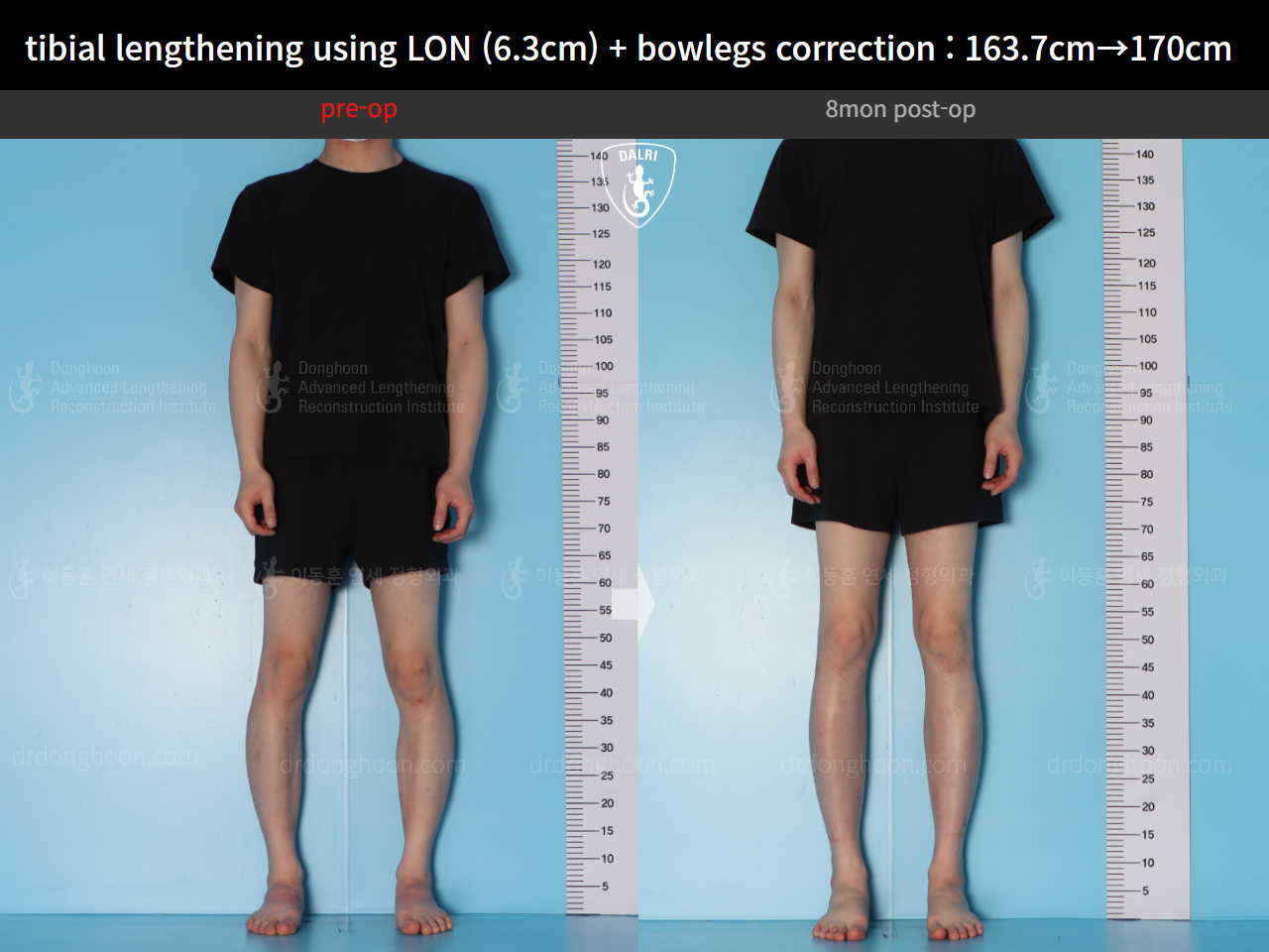 Tibial Lengthening Using LON (6.3cm) + Bowlegs Correction : 163.7cm→ ...