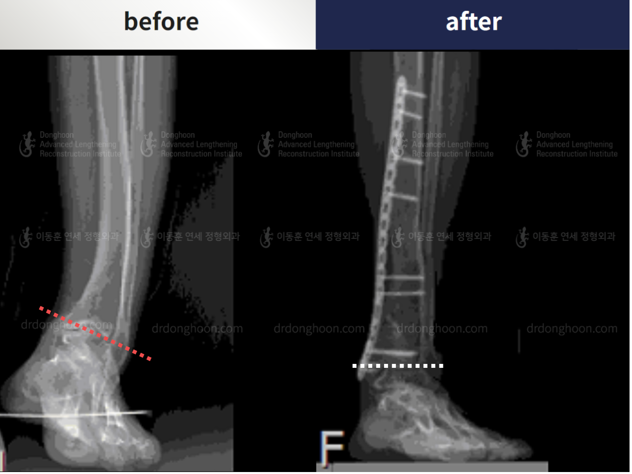 Before and after foot & ankle deformity, case 4248108, image 3, Dr. Donghoon institute (DALRI)