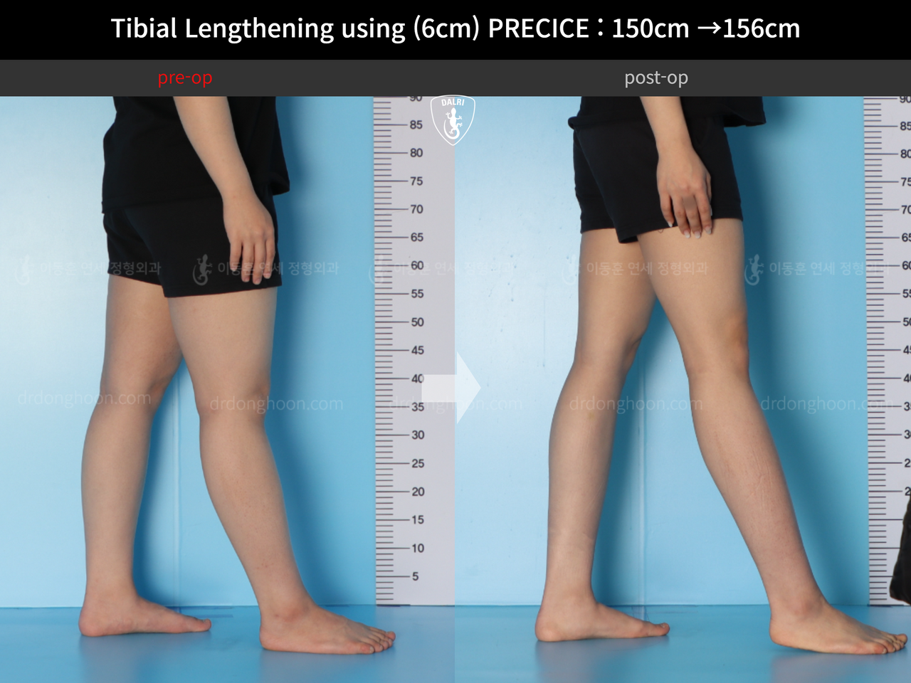Before and after cll precice, case 14065180, image 7, Dr. Donghoon institute (DALRI)