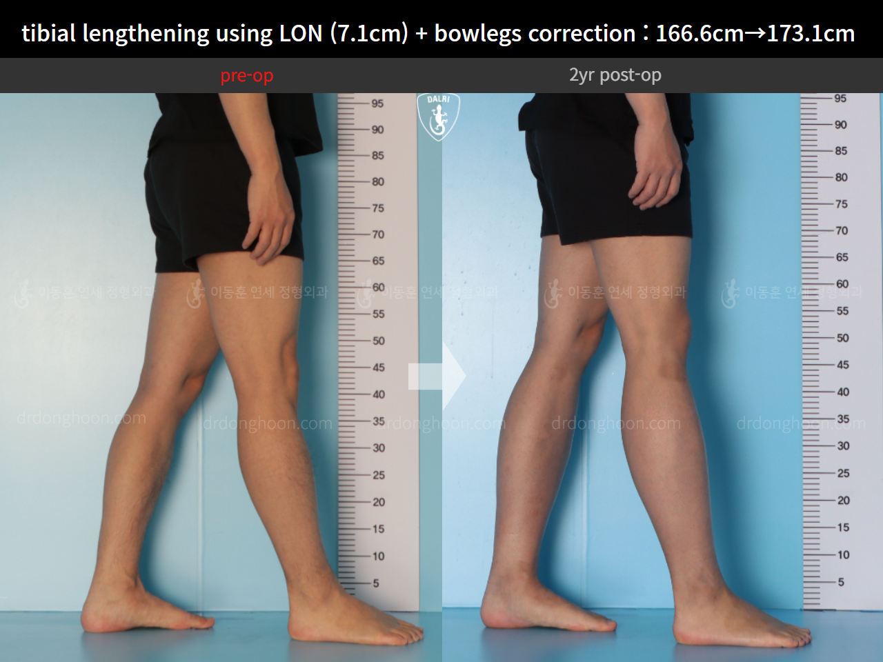 Before and after cll lon, case 14678740, image 9, Dr. Donghoon institute (DALRI)