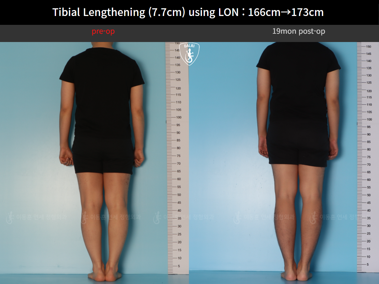 Before and after cll lon, case 126858222, image 2, Dr. Donghoon institute (DALRI)
