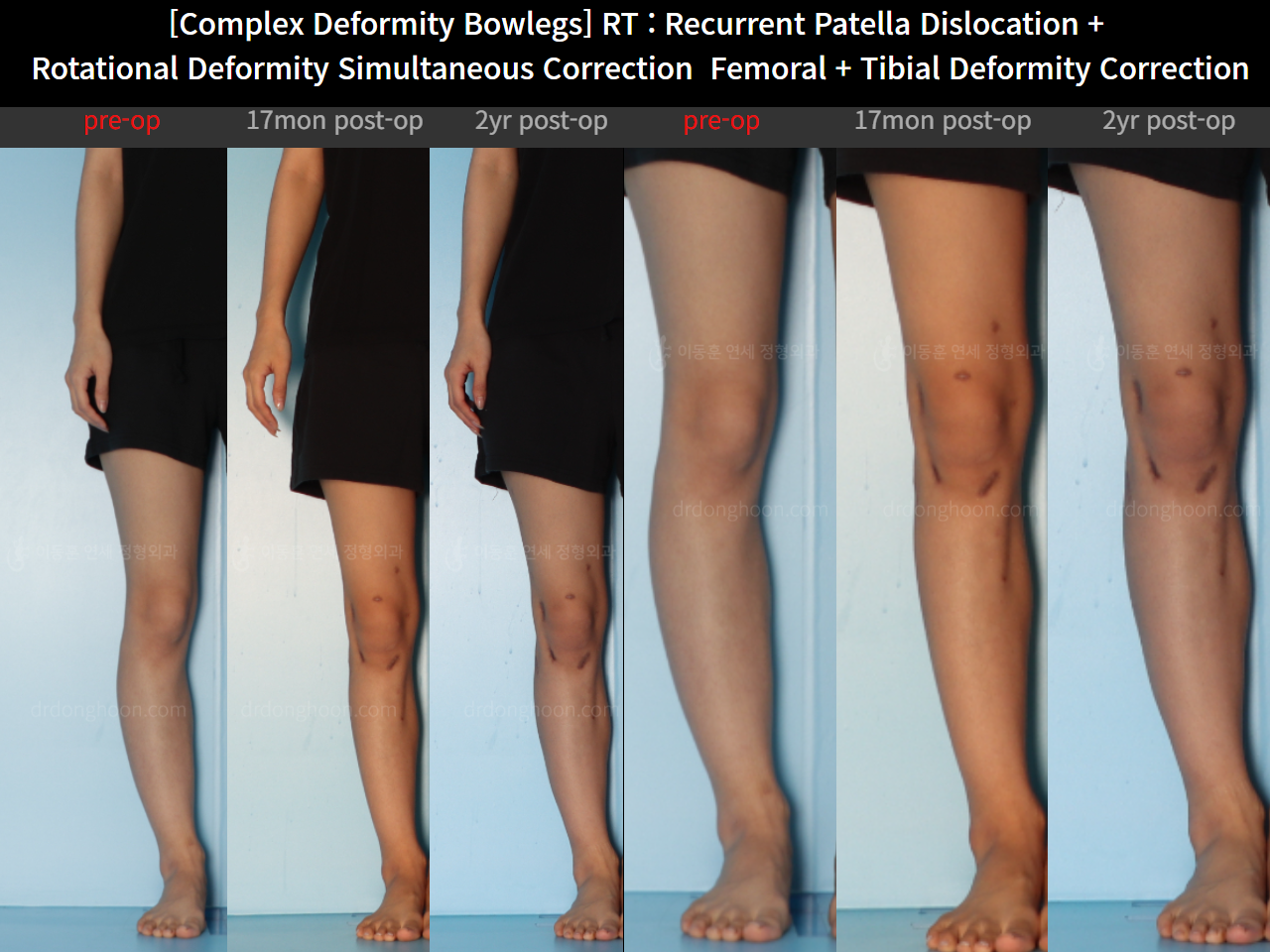 Before and after adult bowlegs, case 14960899, image 7, Dr. Donghoon institute (DALRI)