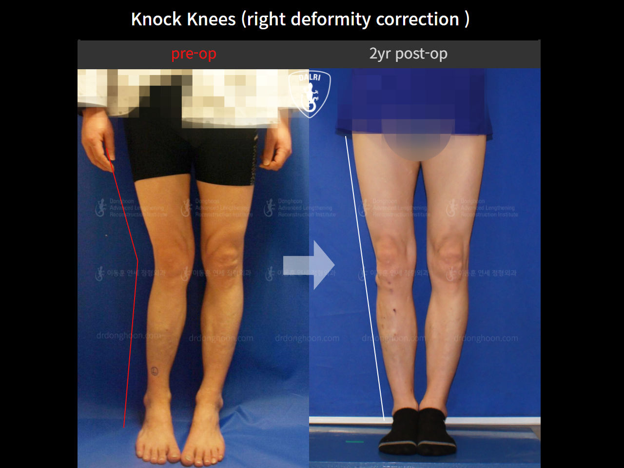 Before and after adult knock knees, case 4795610, image 3, Dr. Donghoon institute (DALRI)