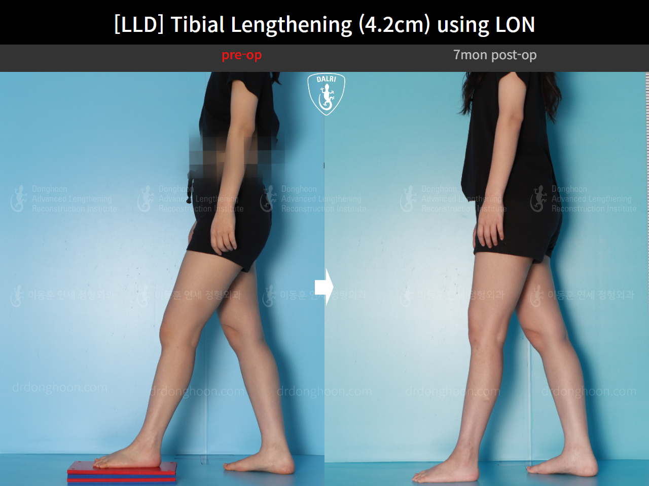 Before and after adult lld, case 16933852, image 5, Dr. Donghoon institute (DALRI)