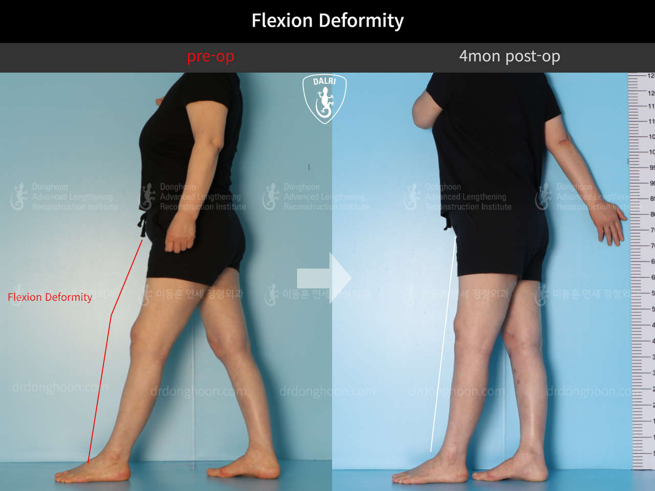 Before and after flexion deformity, case 12586490, image 1, Dr. Donghoon institute (DALRI)