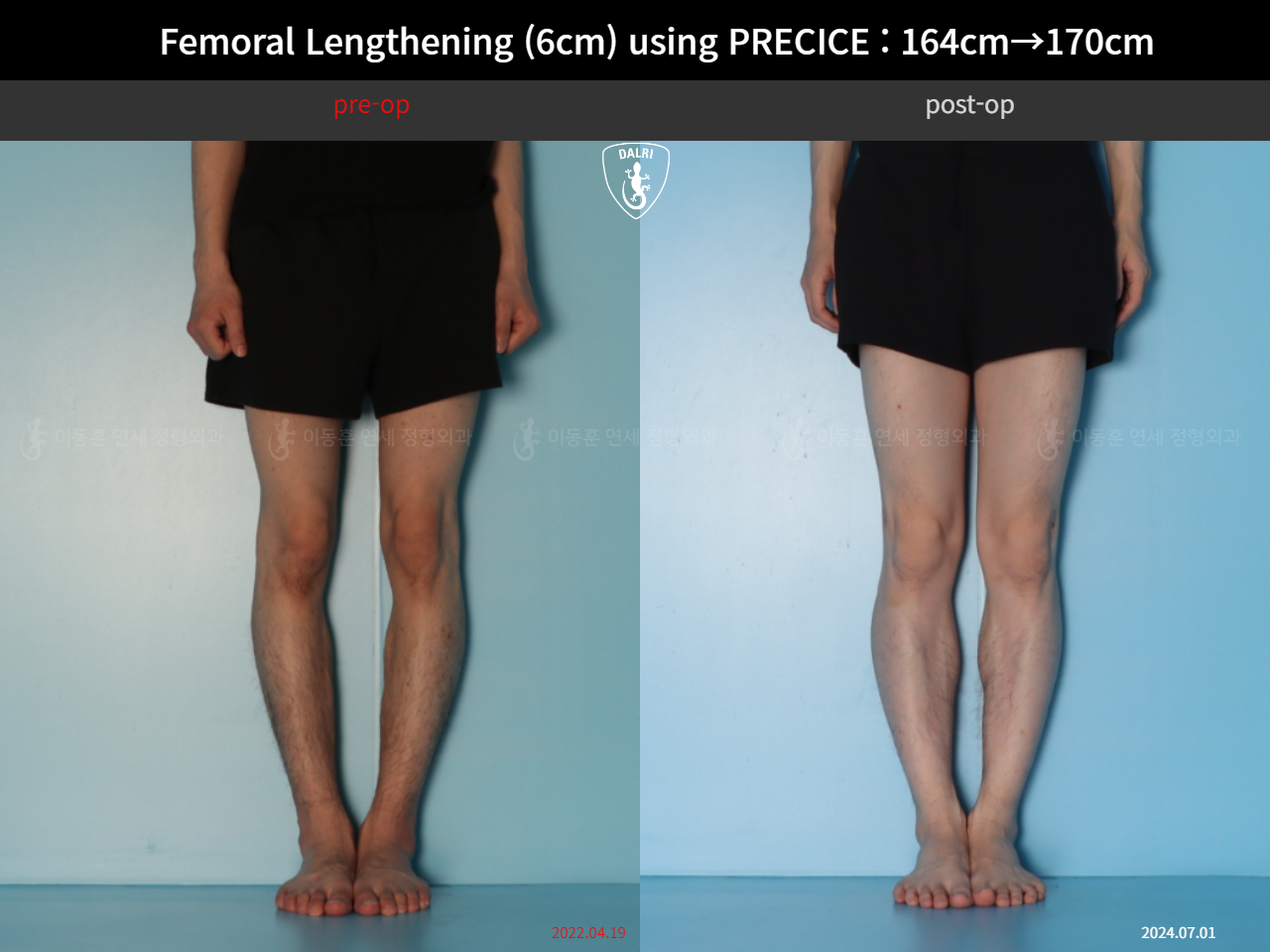Before and after cll precice, case 33570290, image 7, Dr. Donghoon institute (DALRI)