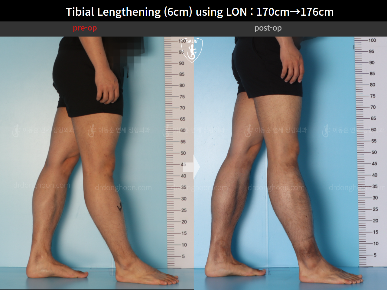 Before and after cll lon, case 15623962, image 8, Dr. Donghoon institute (DALRI)