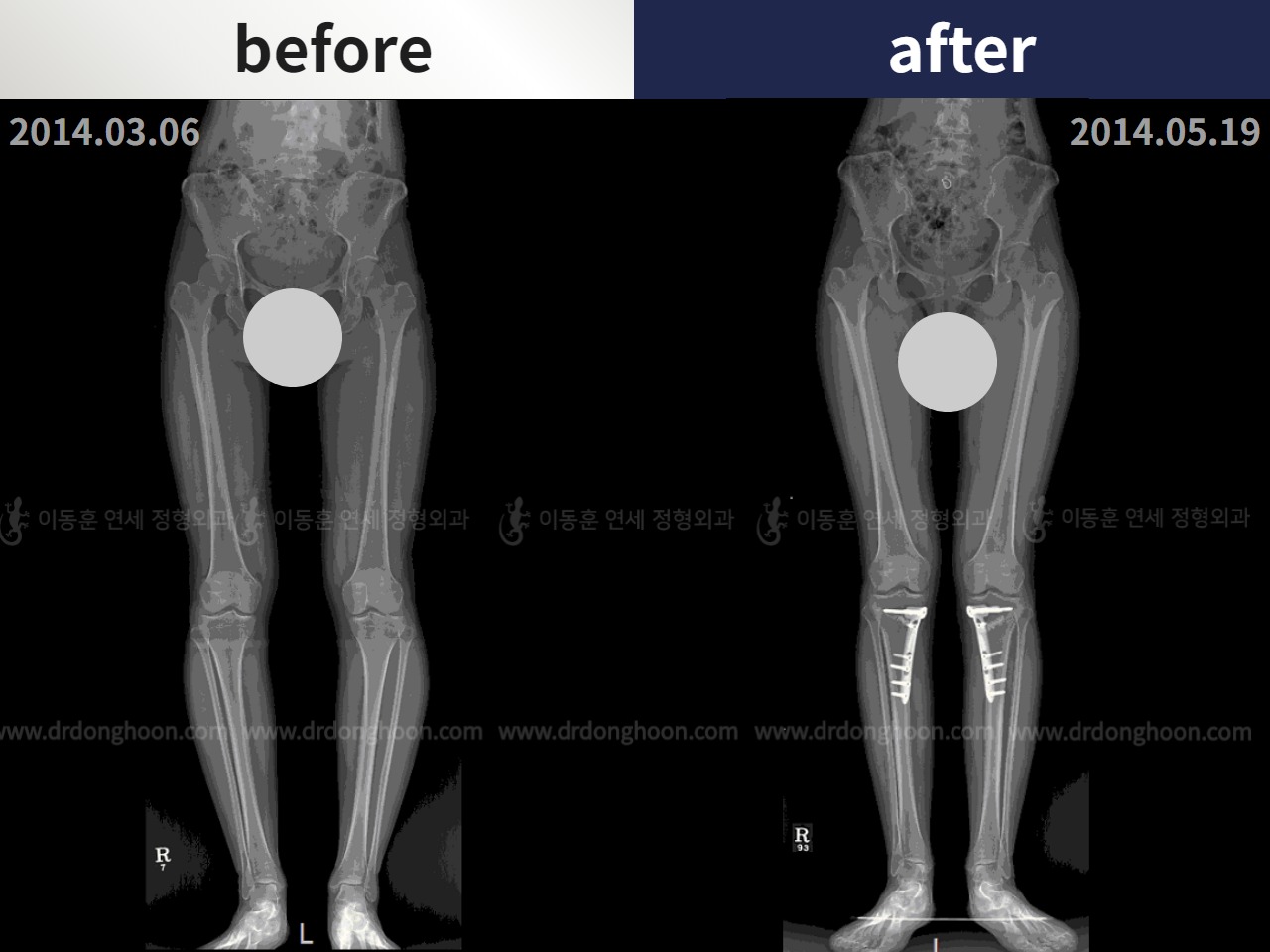 Before and after adult bowlegs, case 4311089, image 2, Dr. Donghoon institute (DALRI)