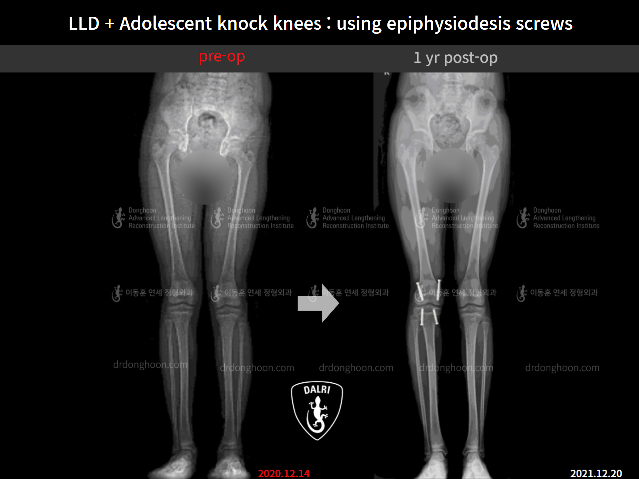 Before and after paediatric & adolescent knock knees, case 9186061, image 9, Dr. Donghoon institute (DALRI)