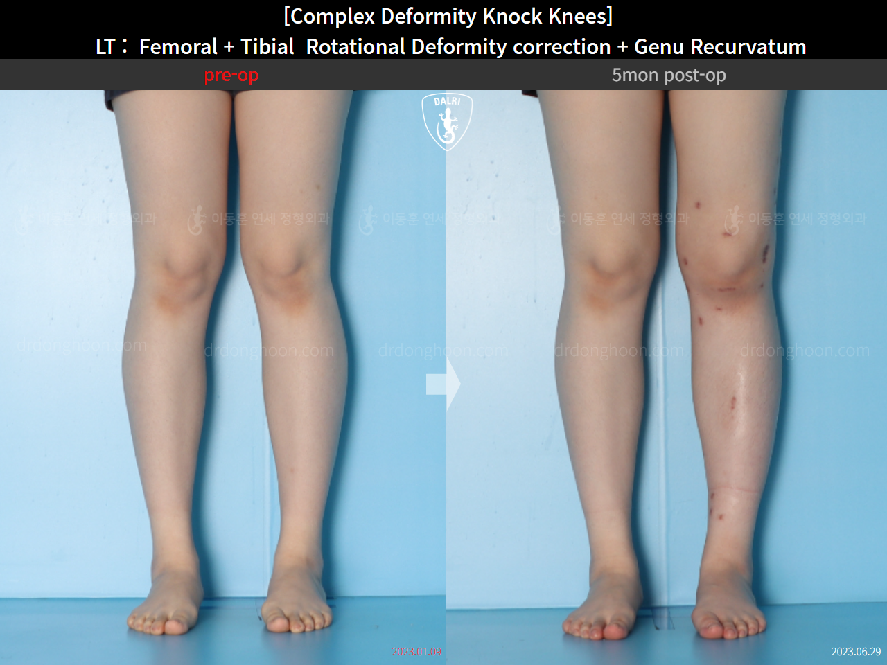Before and after genu recurvatum, case 16212778, image 9, Dr. Donghoon institute (DALRI)