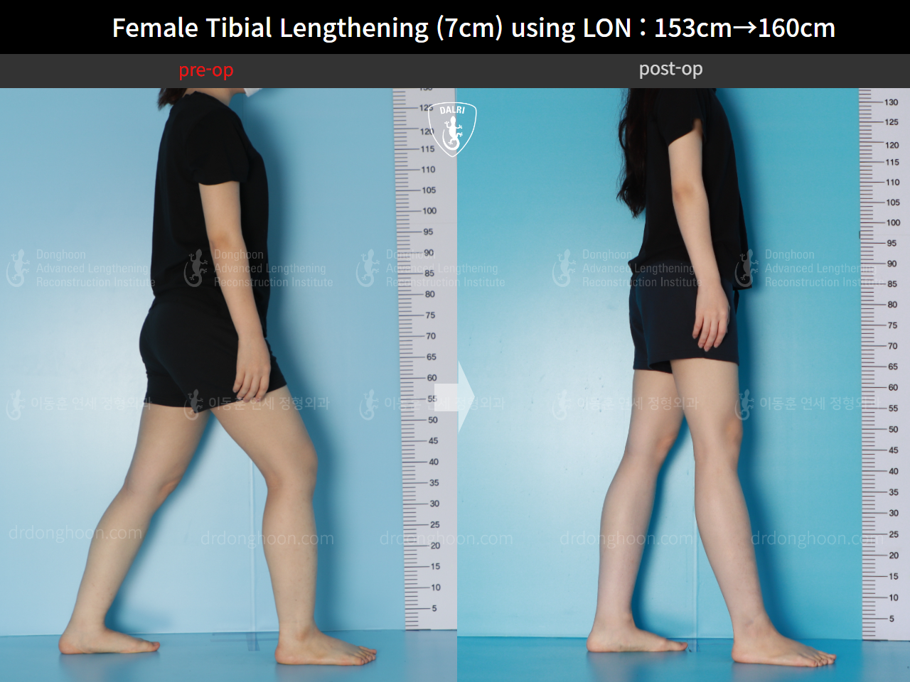Before and after cll lon, case 16044134, image 4, Dr. Donghoon institute (DALRI)